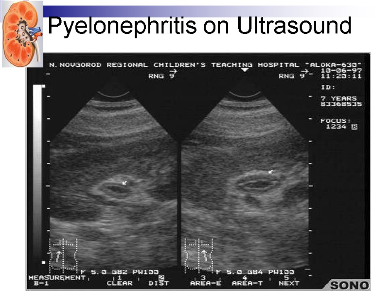 Pyelonephritis on Ultrasound